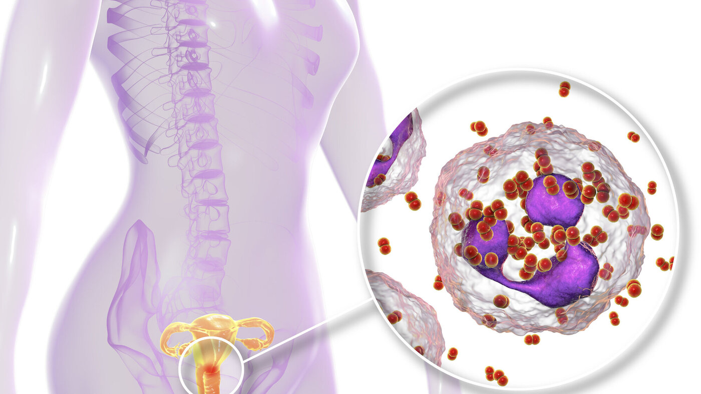 Bildet er en illustrasjon som viser gonoréinfeksjon hos en kvinne. 