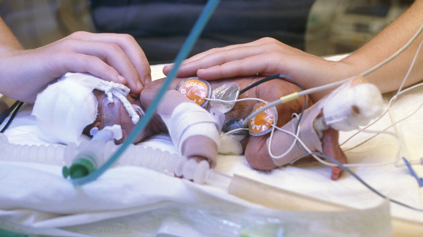 Bildet viser et ekstremt prematurt barn.