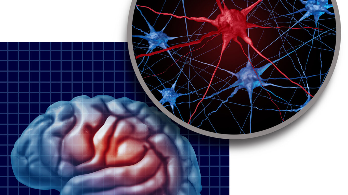 Bildet viser en illustrasjon av en hjerne med Parkinson sykdom
