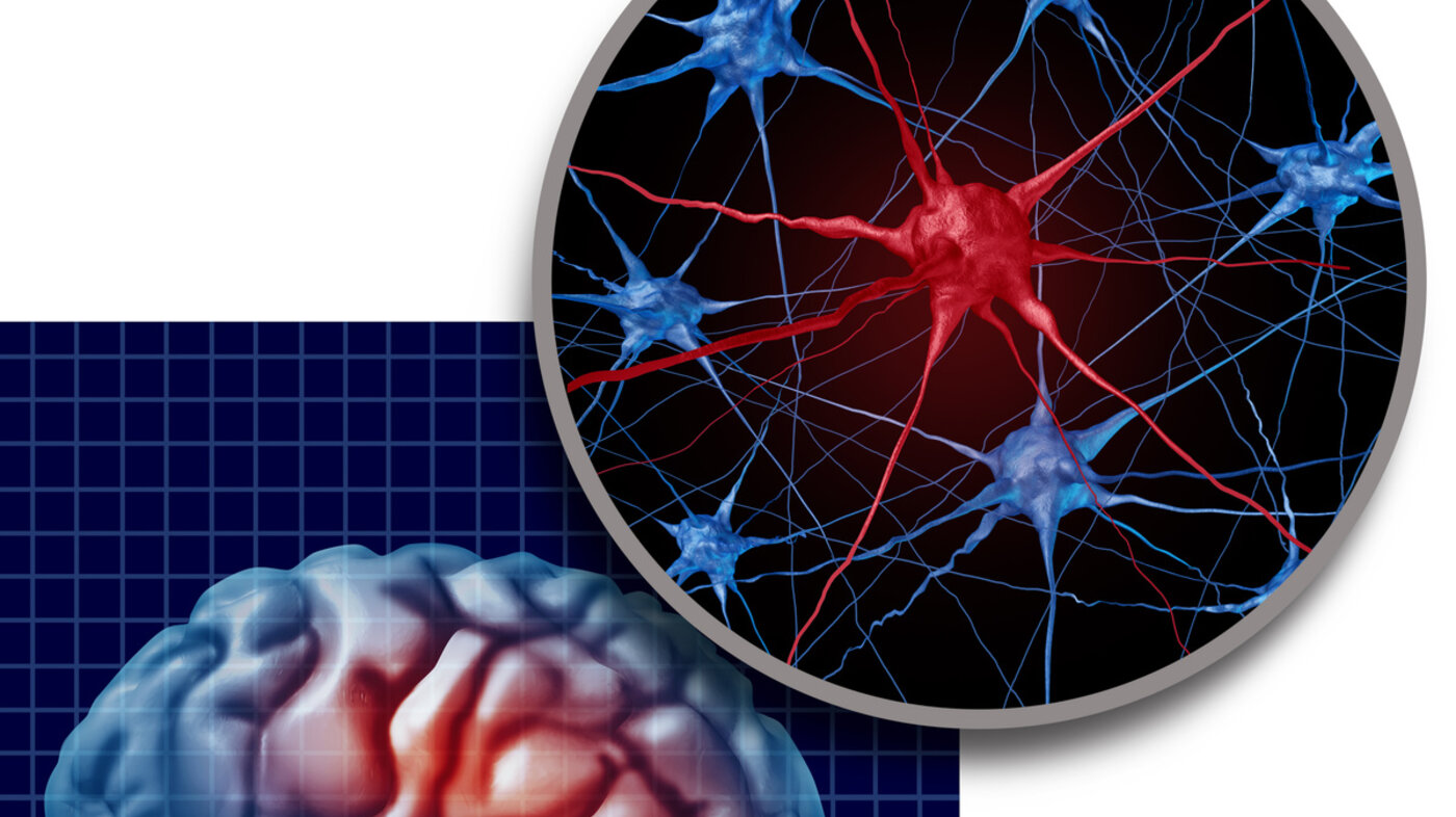 Bildet viser en animasjon av Parkinson Bildet viser en animasjon av Parkinson