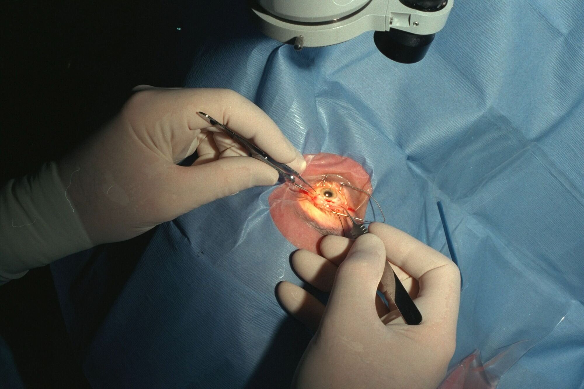 Bildet viser en grå stær-operasjon Bildet viser en grå stær-operasjon