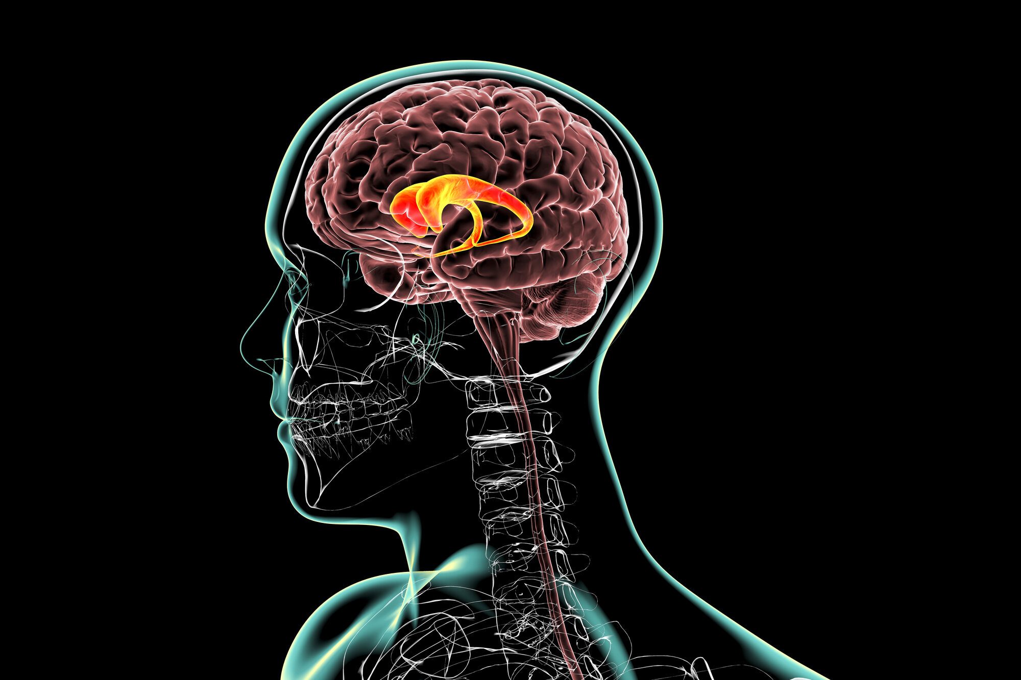 Bildet viser en illustrasjon som viser hvordan Huntington genet angriper hjernen Bildet viser en illustrasjon som viser hvordan Huntington genet angriper hjernen