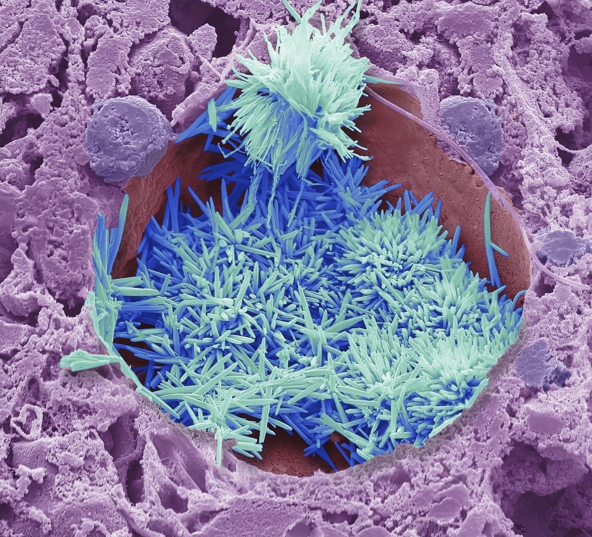 Bildet viser kolesterolkrystaller.