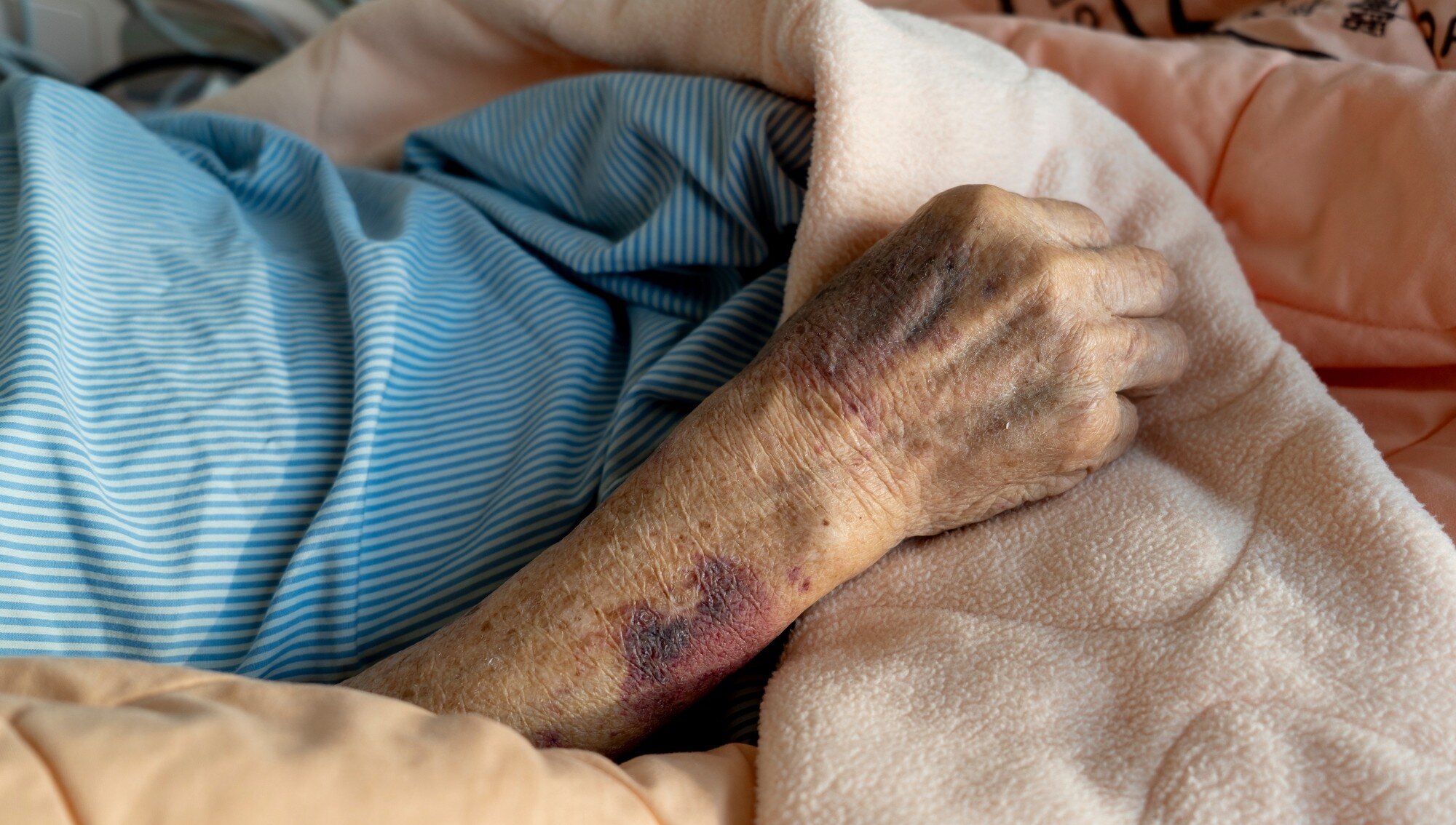 Bildet viser armen til en sykehjemspasient full av blåmerker