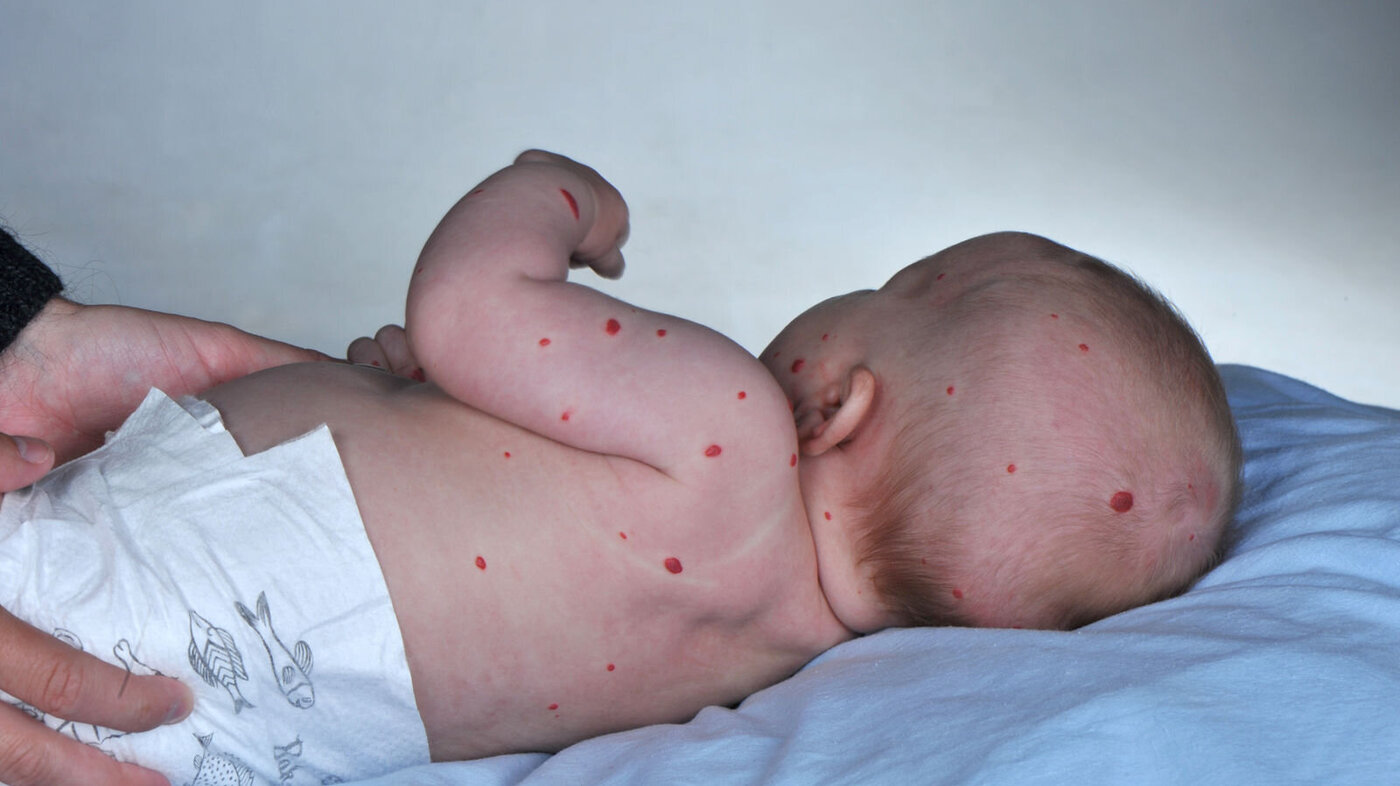 MANGE HEMANGIOMER: Dersom barnet har mer enn fem hemangiomer, er det økt risiko for at det også har hemangiomer i indre organer.