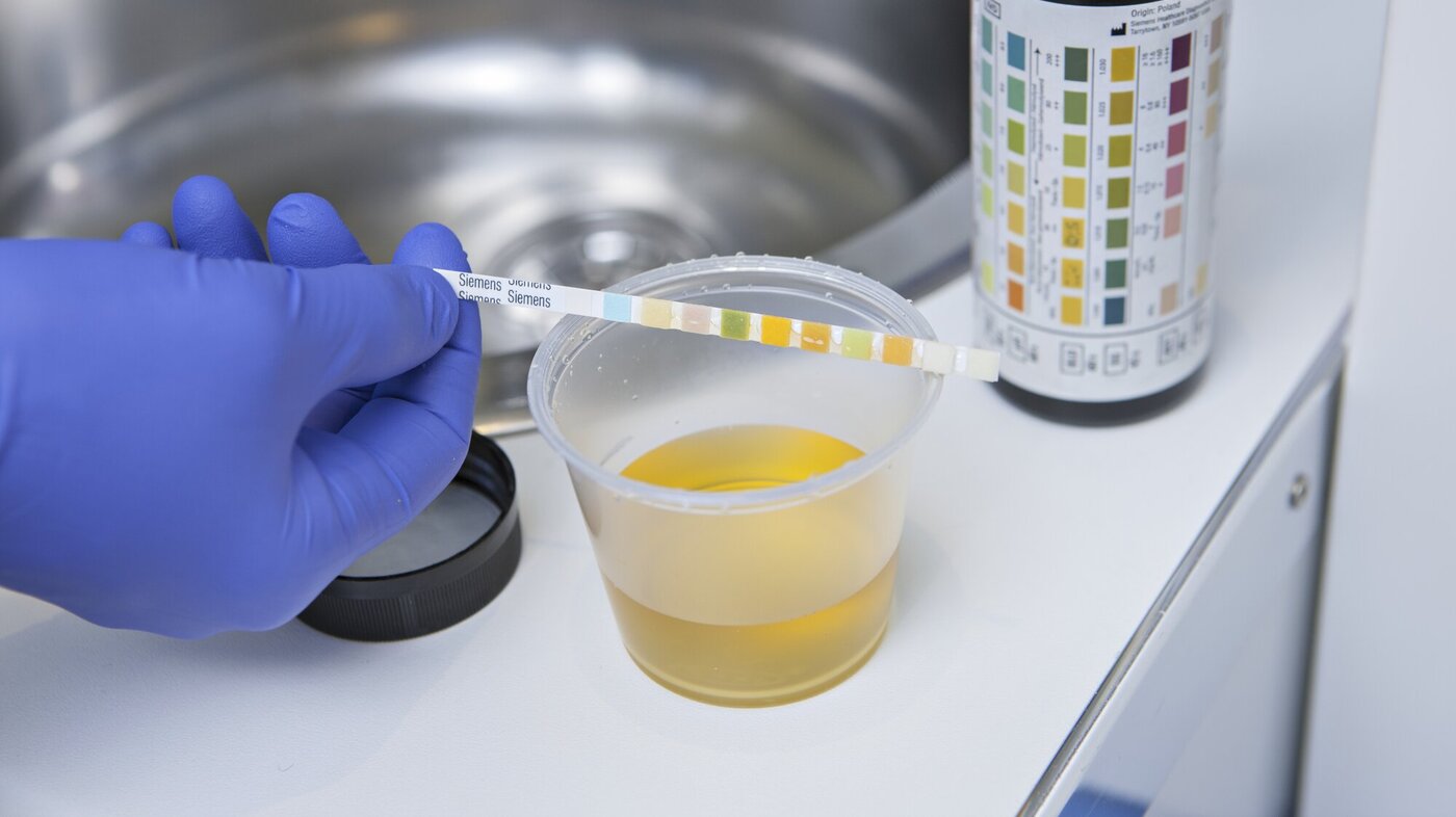 Bildet viser et prøveglass med urin og en strimmel med urinstix.