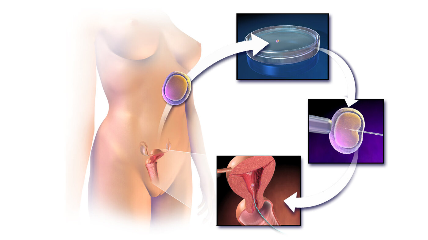 Illustrasjonen viser in vitro-fertilisering