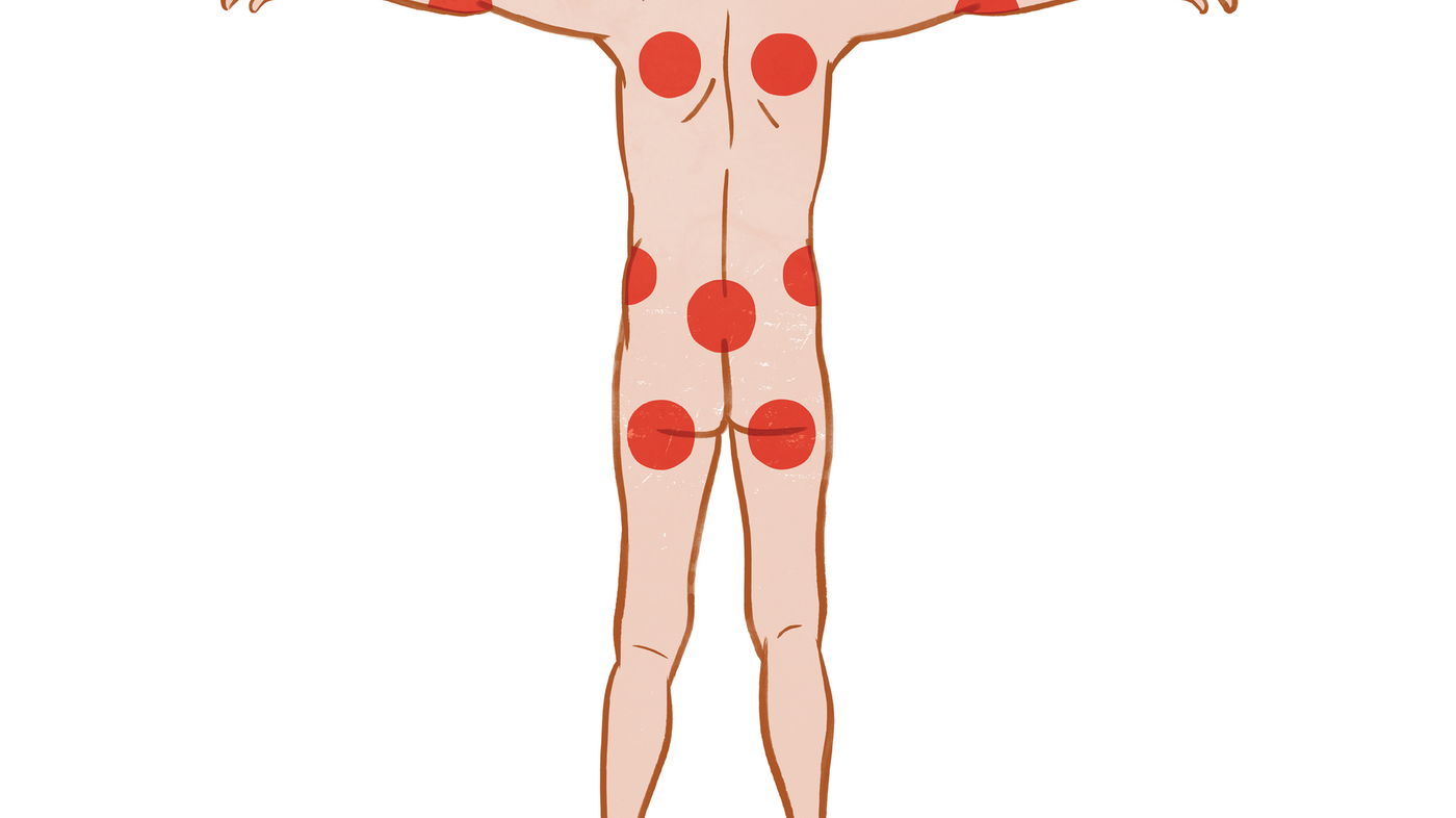 Figur 1. Trykkutsatte punkter ved ryggleie i seng 