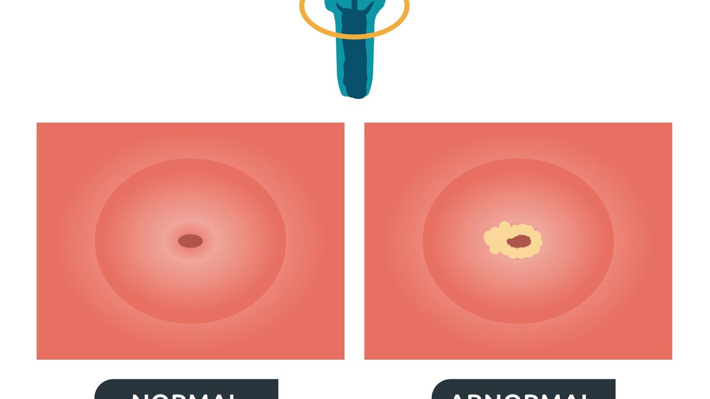 Illustrasjonen viser organene i underlivet med runding rundt livmorhalsen og to utsnitt av livmorhals, en med normale celler og en med celleforandringer.