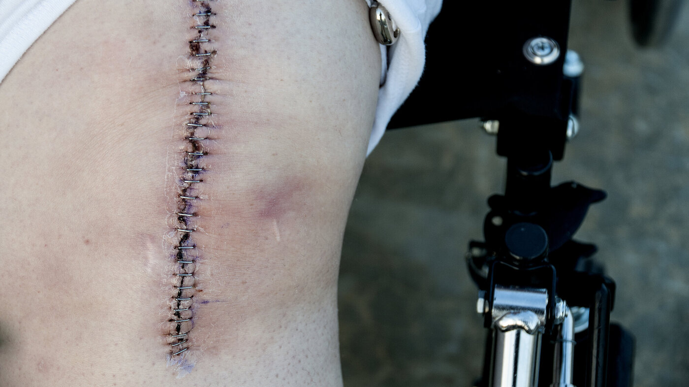 Bildet viser et kne med et stort, loddrett arr etter en total kneoperasjon (total kneprotese).