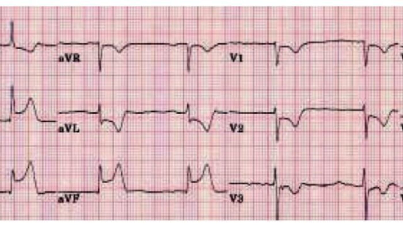 Bilde av EKG