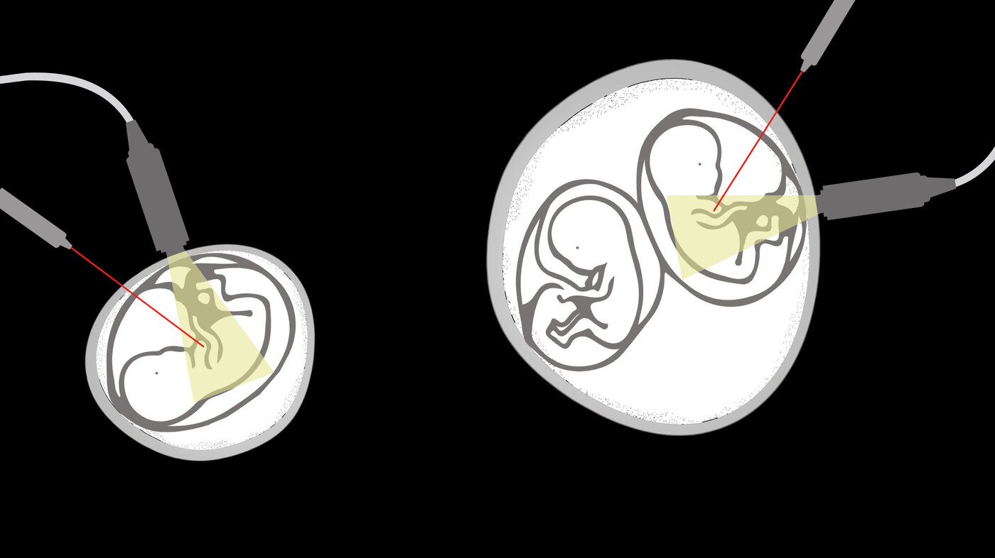 Illustrasjon som viser fosterreduksjon der det er ett embryo, og ett hvor det er to.
