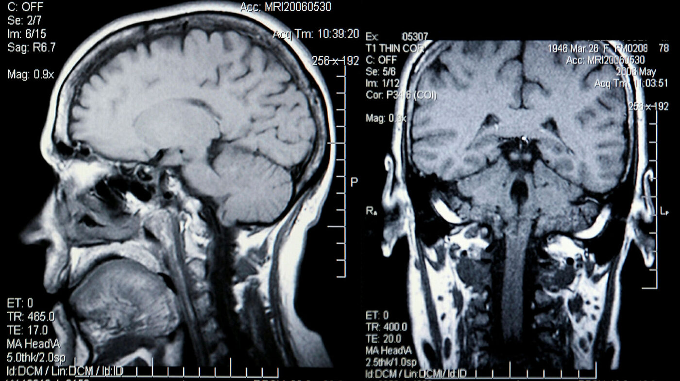 Røntgenbilde av hodeskalle