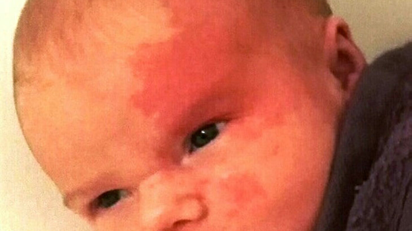 Barn med rødlige flekker i huden, såkalte «portvinsflekker», som er en type fødselsmerke. 