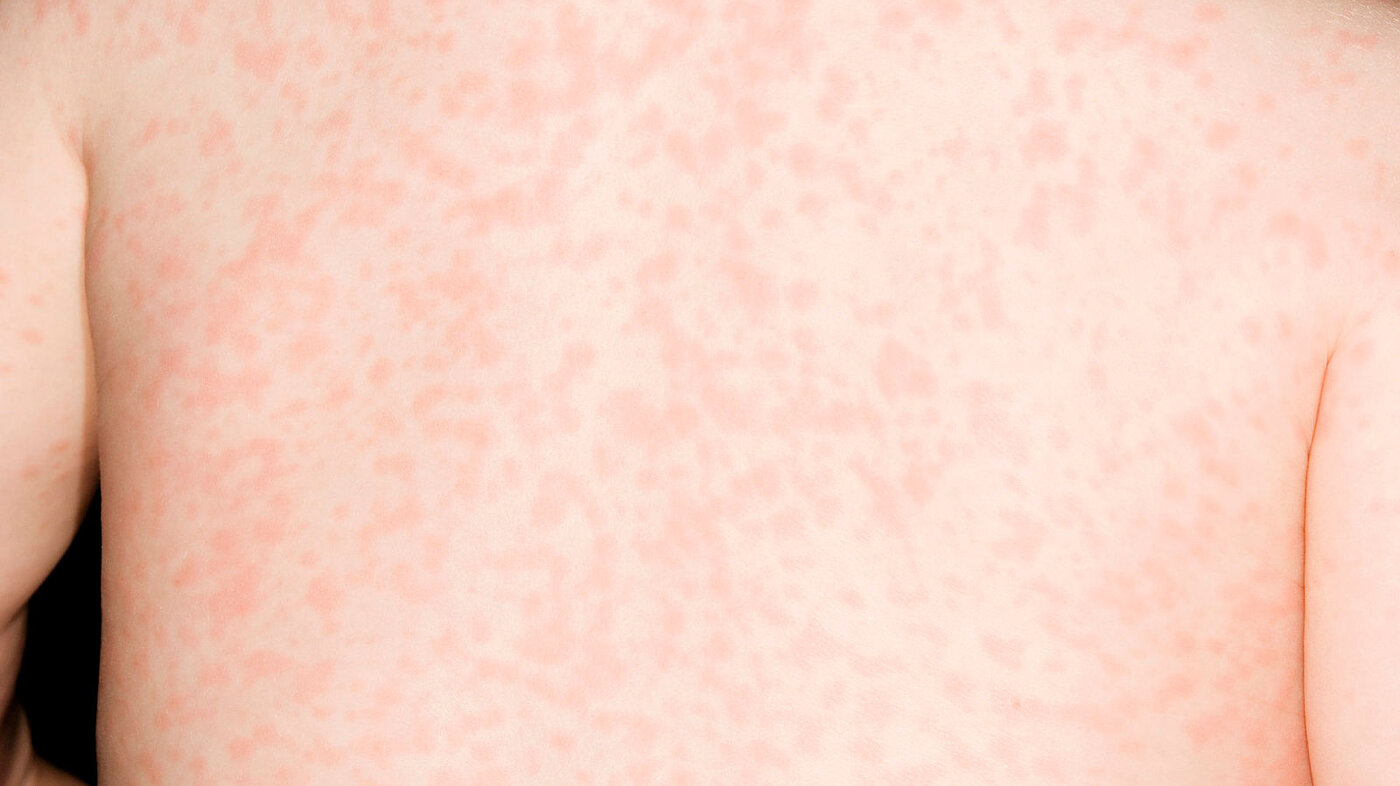 Bilde av ryggen til et lite barn som er rammet av meslinger