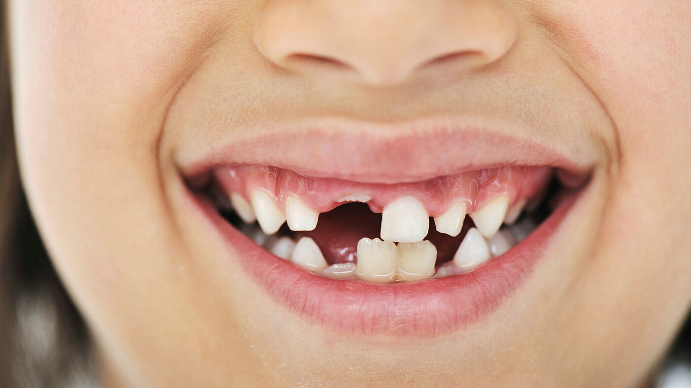 Bildet viser tanngarden til en ung gutt eller jente som har mistet noen av fortennene.
