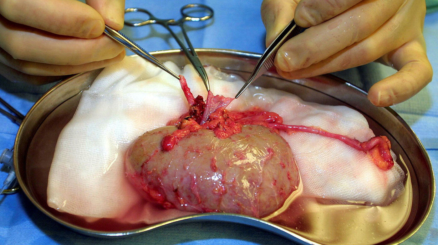 Bildet viser en nyre som er blitt operert ut av en mann. Nyren ligger på et fat, og to hender med instrumenter og saks arbeider.