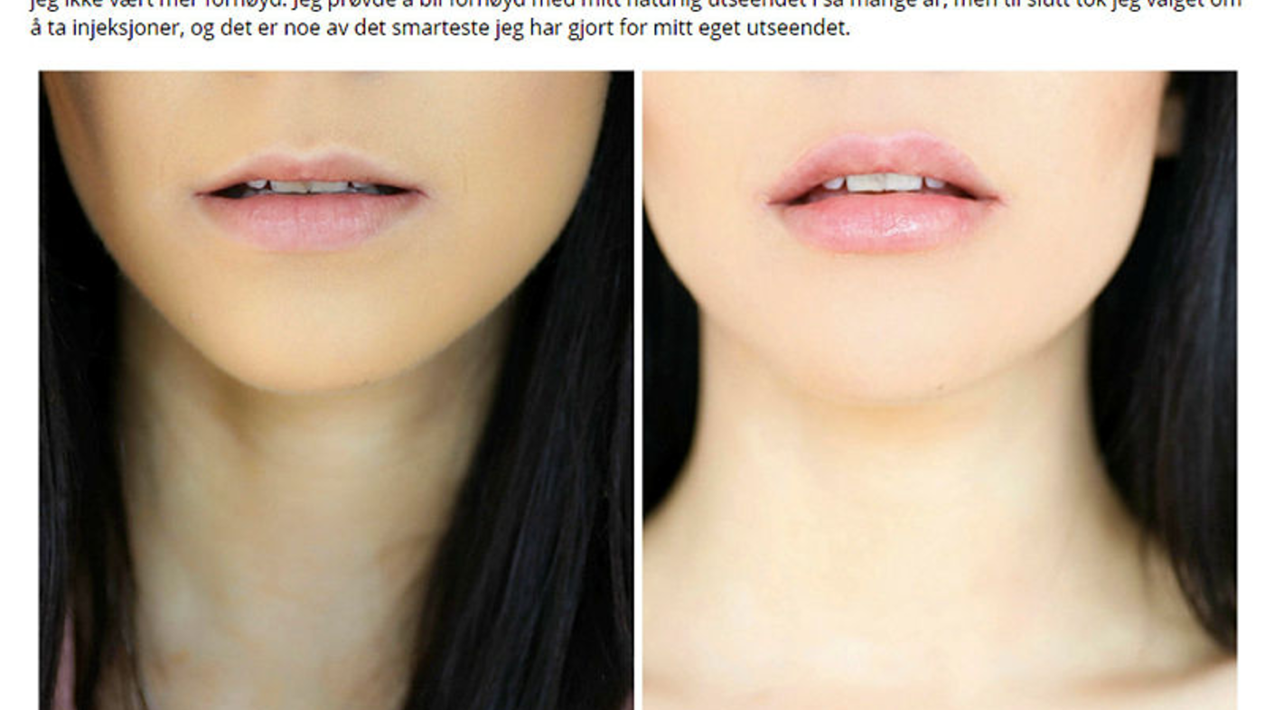 Bildet viser før-og-etter-bilder av bloggeren Stina Marie Bakken, som har tatt Restylane i leppene.