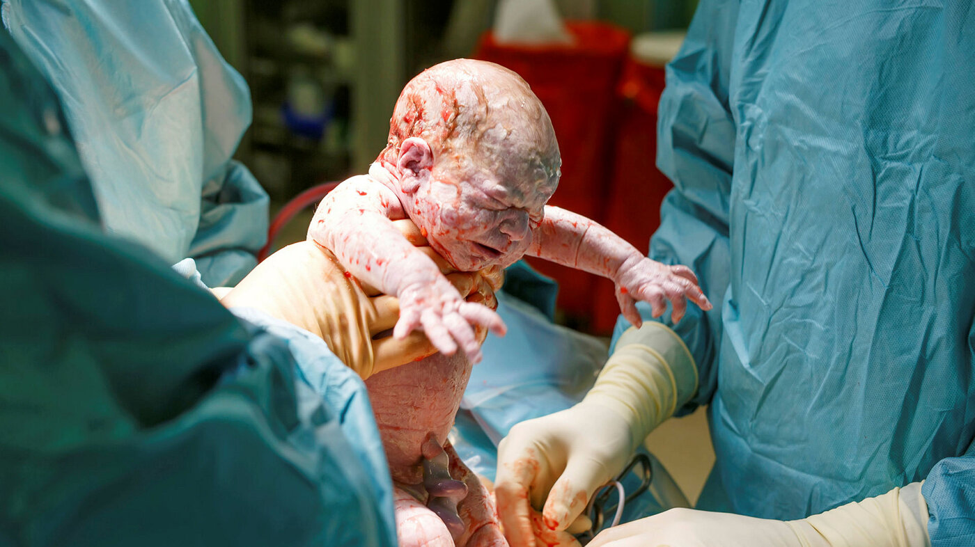 Baby som blir født ved keisersnitt Bildet viser en baby som akkurat er født ved keisersnitt