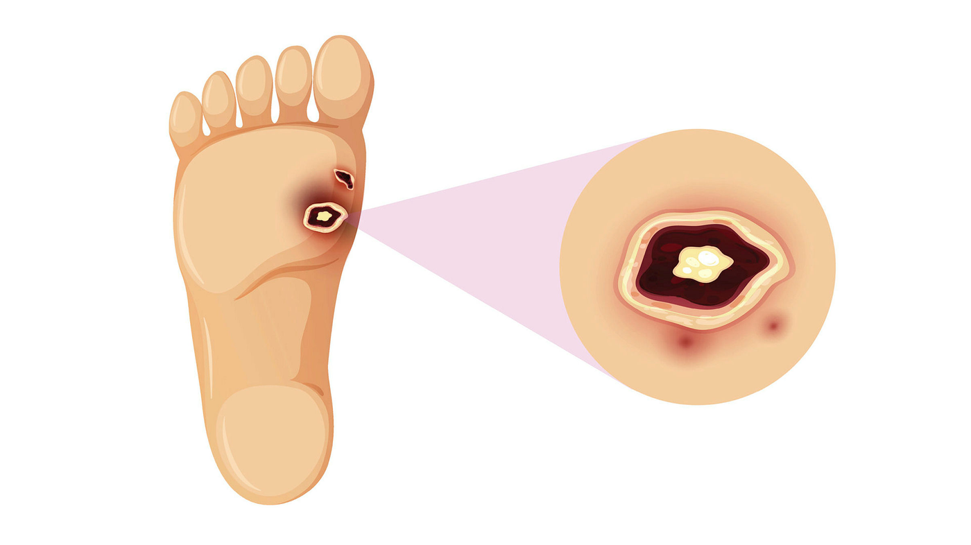 Illustrasjonen viser et diabetessår under foten som er forstørret opp.