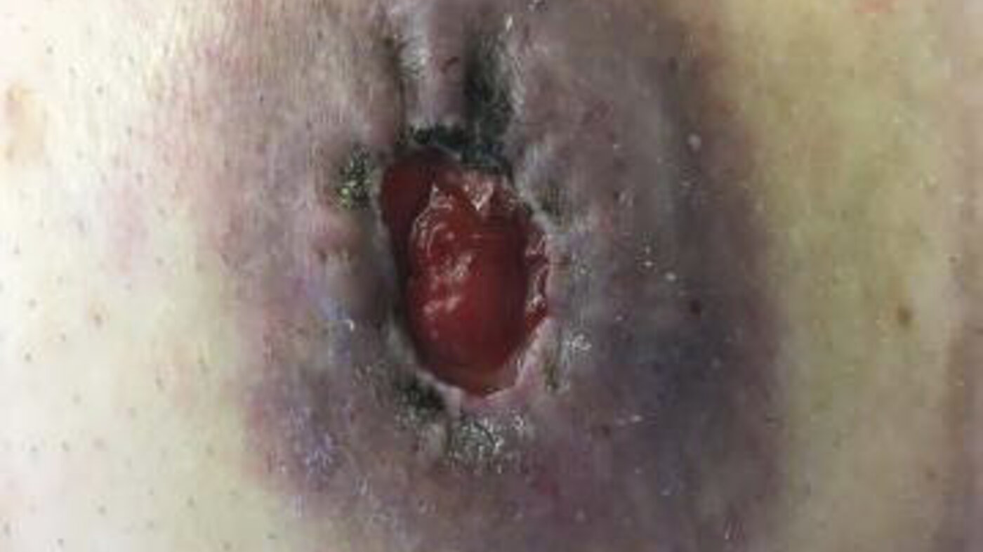 Urin på huden ved urostomi