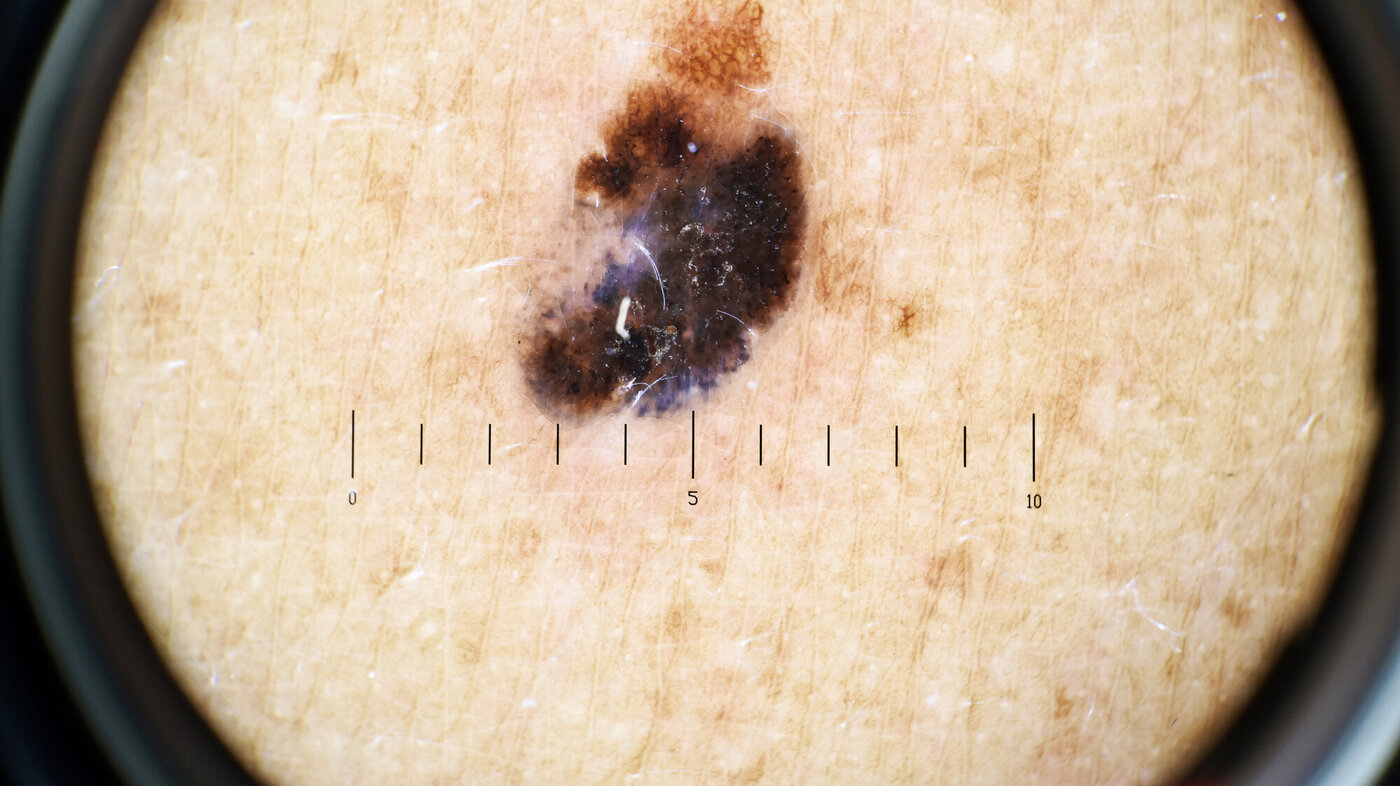 Bildet viser malignt melanom.