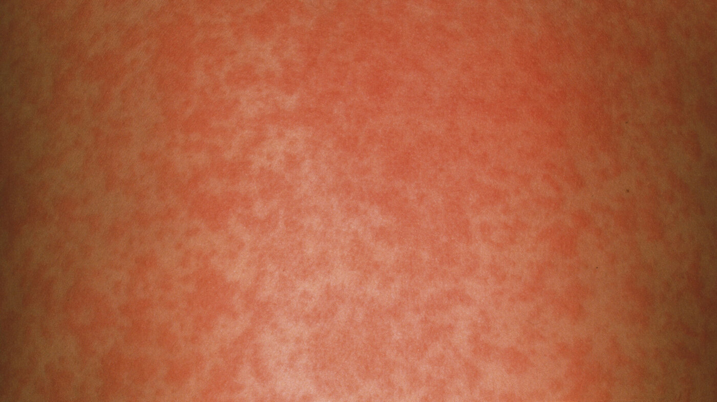 Bilde av ryggen til et barn som har meslinger
