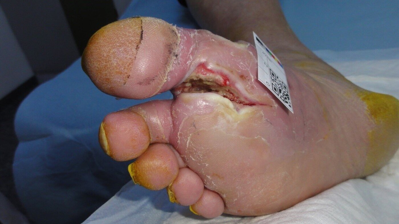 Bildet viser et diabetisk fotsår med infeksjon mellom første og andre tå