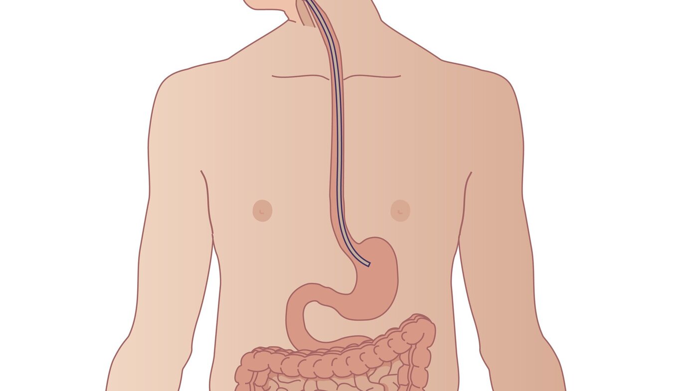 Illustrasjonen viser en ernæringssonde lagt ned på en mann.