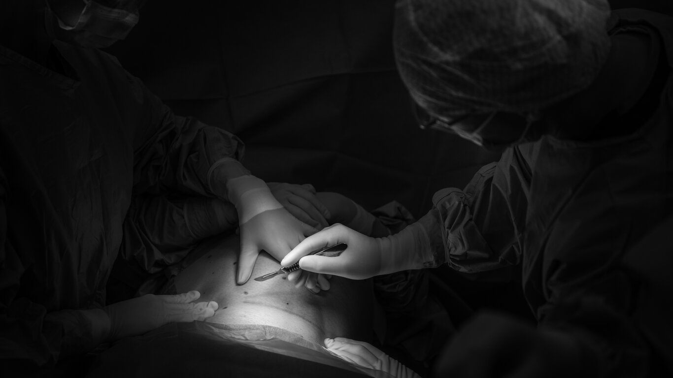 Bildet viser MAC-keisersnitt