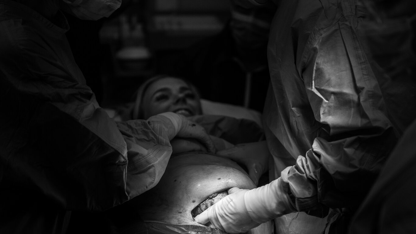 Bildet viser MAC-keisersnitt