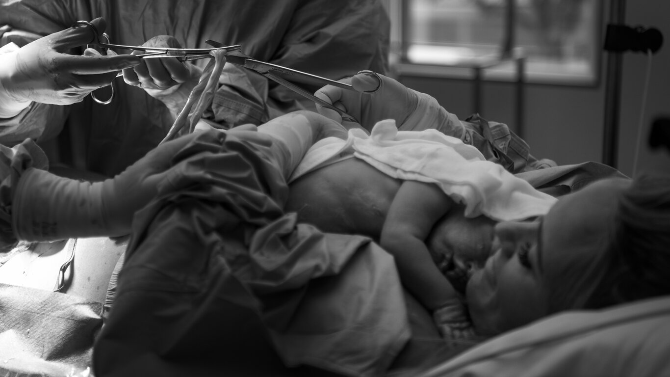 Bildet viser MAC-keisersnitt