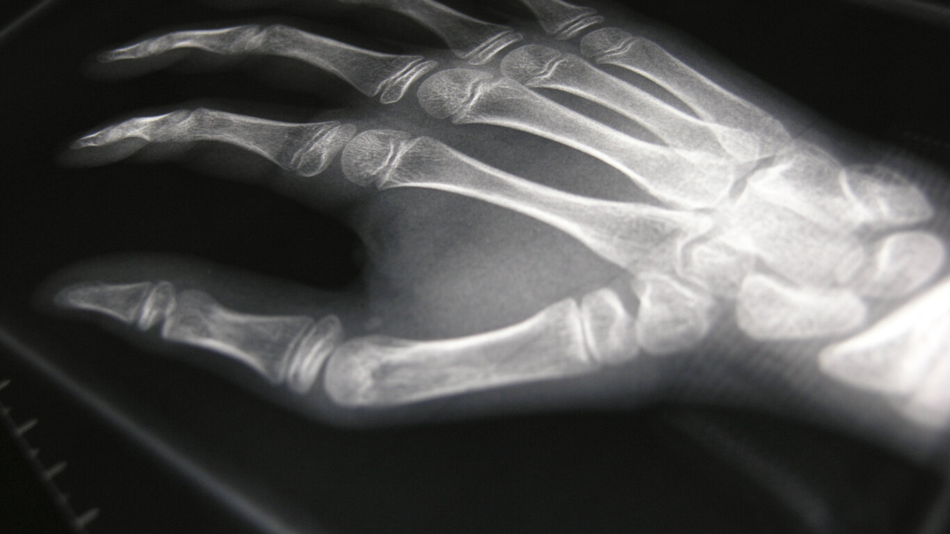 R&oslash;ntgen av h&aring;nd