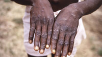 Bildet viser en person som viser frem hender som har utslett forårsaket av apekopper