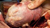 Bilde viser transplantasjon av nyre
