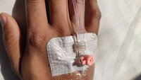 The photo shows a hand with a venous catheter in the vein