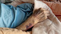 Bildet viser armen til en sykehjemspasient full av blåmerker