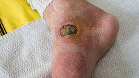 Bildet viser en fot med et stygt diabetessår ved siden av ankelen på innsiden av foten.