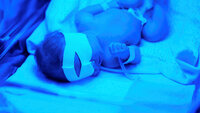 Bildet viser en nyfødt baby som ligger i en lyskasse og får lysterapi mot gulsott.