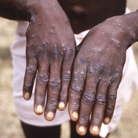 Bildet viser en person som viser frem hender som har utslett forårsaket av apekopper