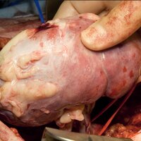 Bilde viser transplantasjon av nyre