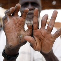 En eldre mann viser frem hender rammet av lepra.