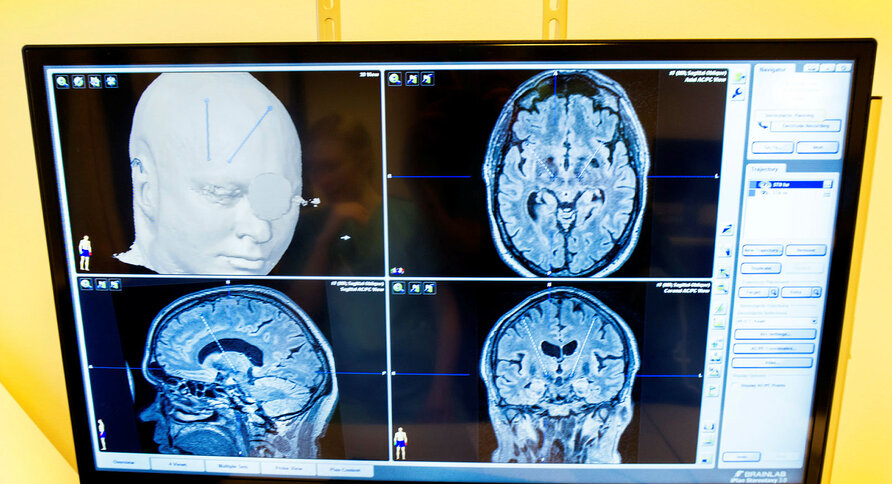 CT-bilde av pasient med Parkinsons sykdom